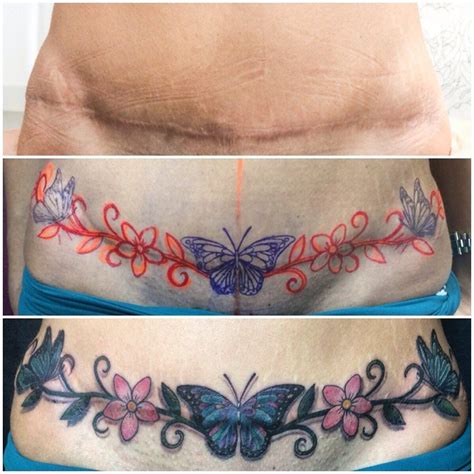 tummy tuck tattoo cover up